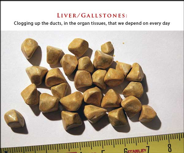 Gallstones